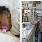 Des bébés siamois séparés avec succès en Afrique du Sud