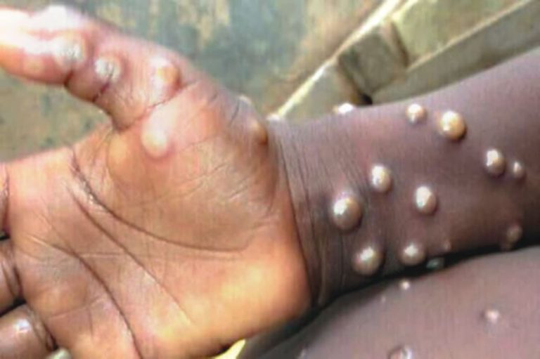 Une épidémie de mpox est à l’origine de 581 décès depuis janvier en RDC