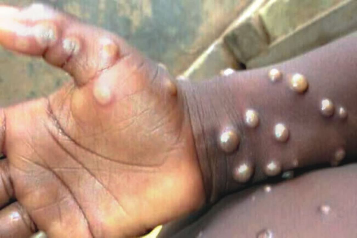 Une épidémie de mpox est à l’origine de 581 décès depuis janvier en RDC