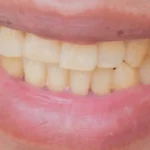Bon à savoir: 02 Causes Majeures du Jaunissement des Dents