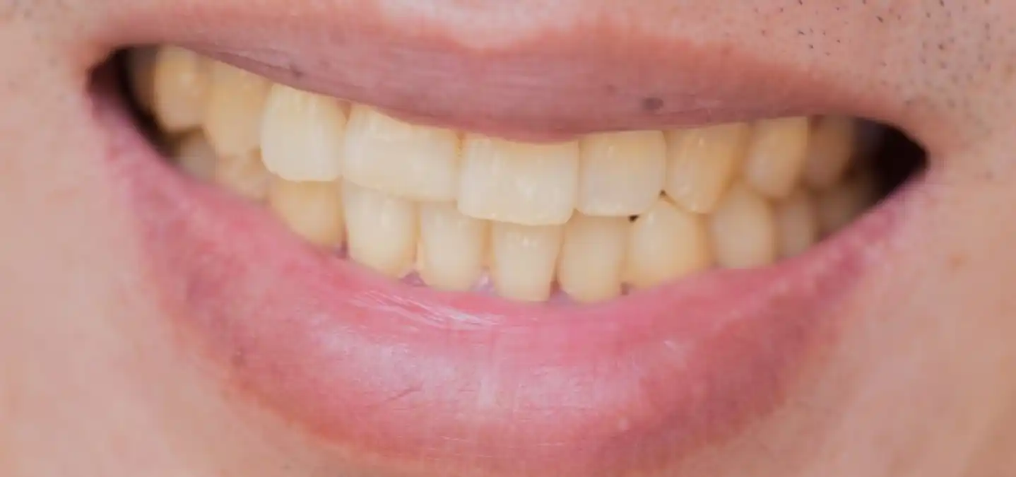 Bon à savoir: 02 Causes Majeures du Jaunissement des Dents