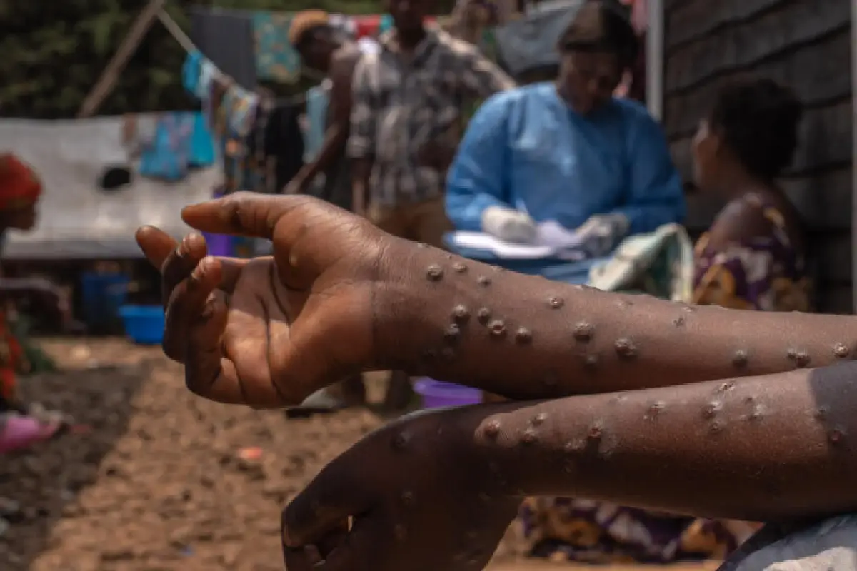 Un patient souffrant de mpox est assis sur un banc de l'hôpital de Kavumu, à 30 kilomètres au nord de Bukavu, dans l'est de la RD Congo, le 24 août 2024. © Glody Murhabazi, AFP